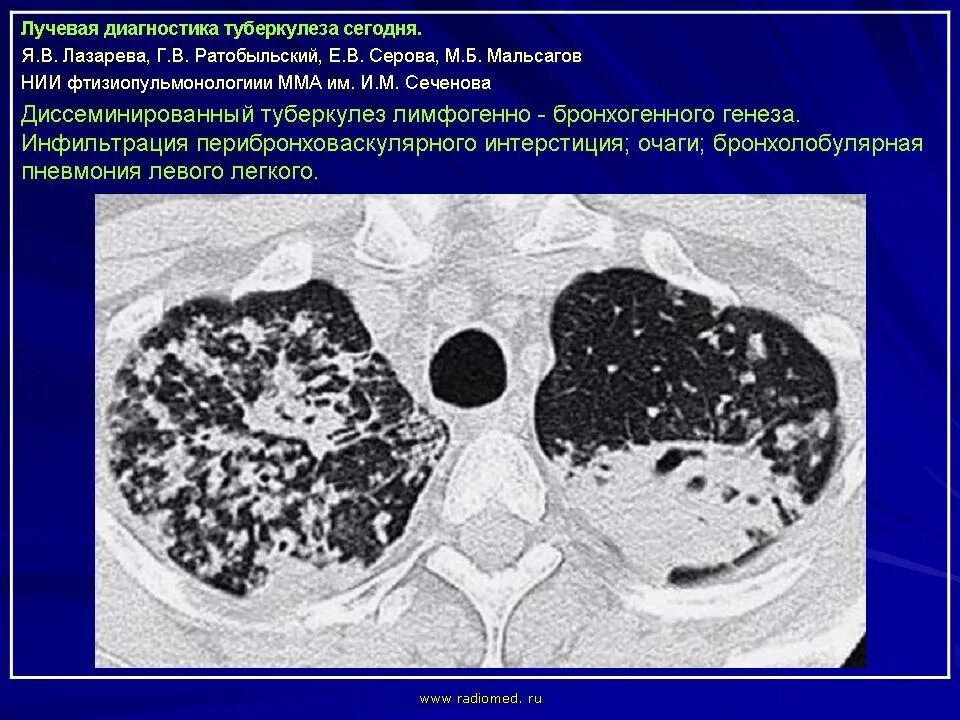 Лимфогенный туберкулез. Диссеминированный туберкулез на кт. Диссеминированный туберкулез легких на кт. Диссеминированный кавернозный туберкулез кт. Гематогенно-диссеминированный туберкулез легких кт.