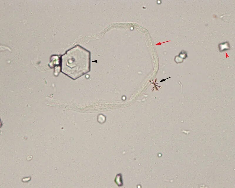Повышен цистин в моче. Кристаллы билирубина в моче микроскопия. Билирубин в моче микроскопия. Кристаллы билирубина в моче под микроскопом. Трипельфосфаты в моче микроскопия.