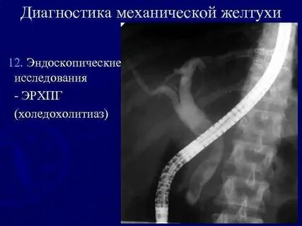 Холедохолитиаз это