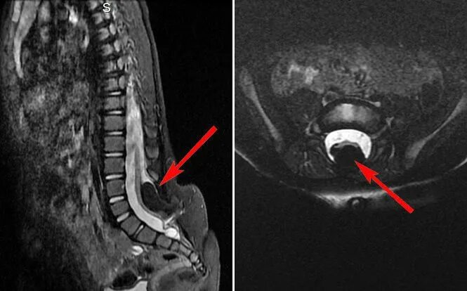 Киста в пояснице. Липома терминальной нити. Эпидуральный липоматоз мрт. Липома терминальной нити позвоночника. Липома терминальной нити спинного мозга на мрт.