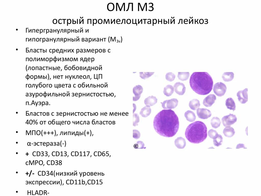 Мозг при остром лейкозе. Острый промиелоцитарный лейкоз м3. Острый миелобластный лейкоз картина крови. Острый промиелоцитарный лейкоз гемограмма. Гипогранулярный вариант острый промиелоцитарный лейкоз.