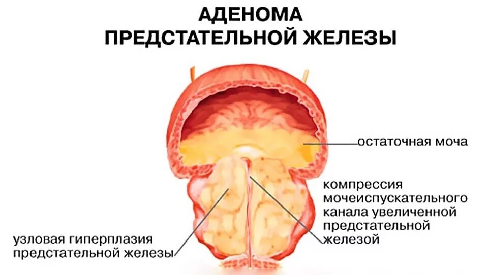 Простата крупный план. Аденома предстательной железы. Гиперплазия предстательной железы. Доброкачественная гиперплазия предстательной железы. ДГПЖ предстательной железы что это такое.