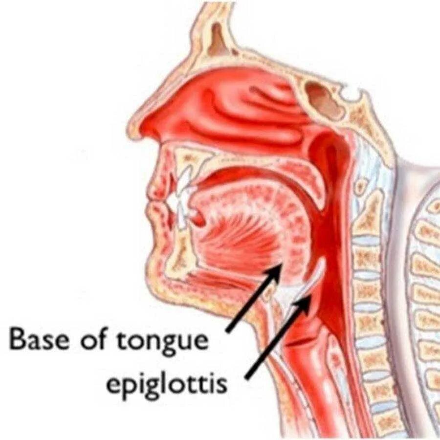 Эпиглоттит симптомы. Эпиглоттит надгортанник. Воспаление надгортанника.