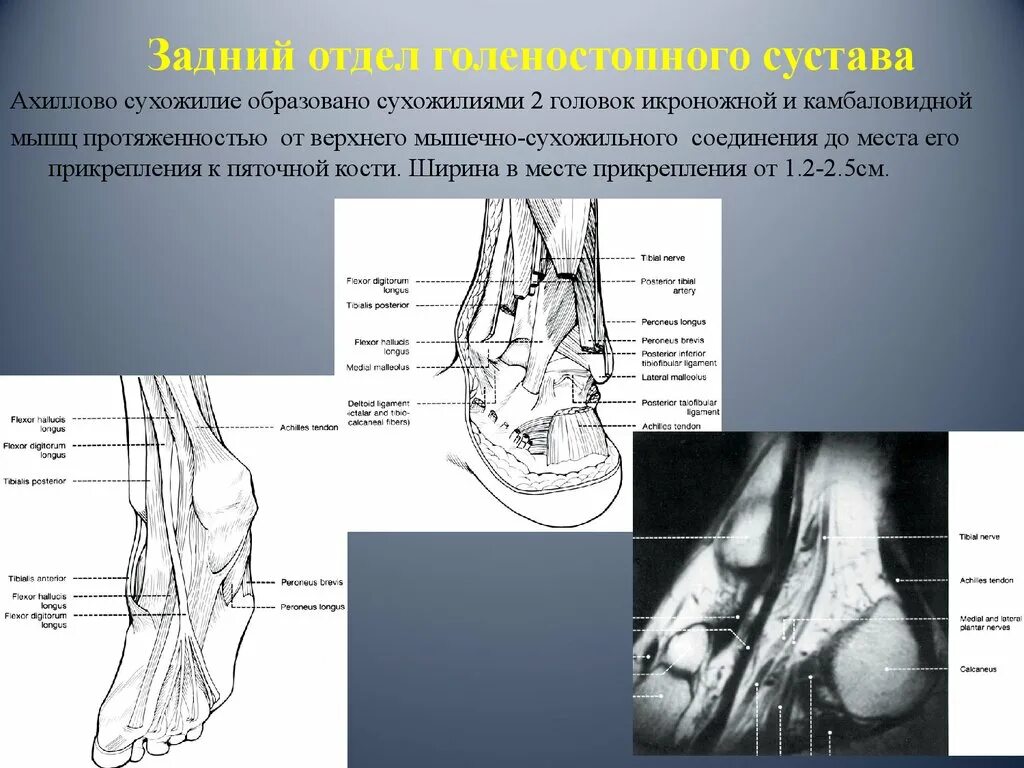 Обызвествление места прикрепления сухожилия