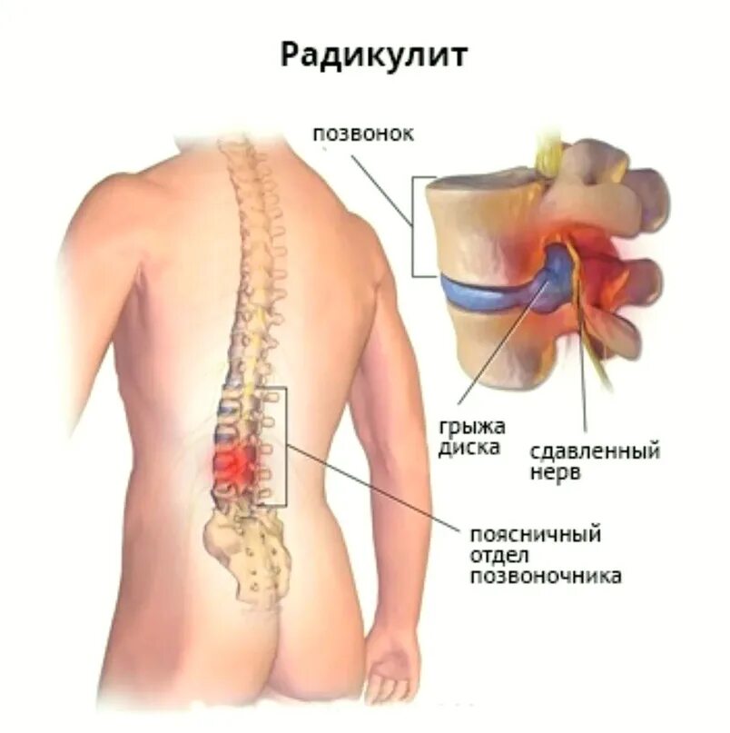 Радикулопатия поясничного отдела. Радикулопатия поясничного отдела