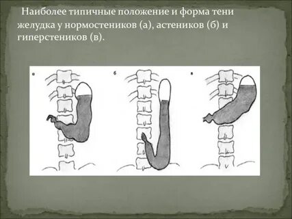 Положение желудка