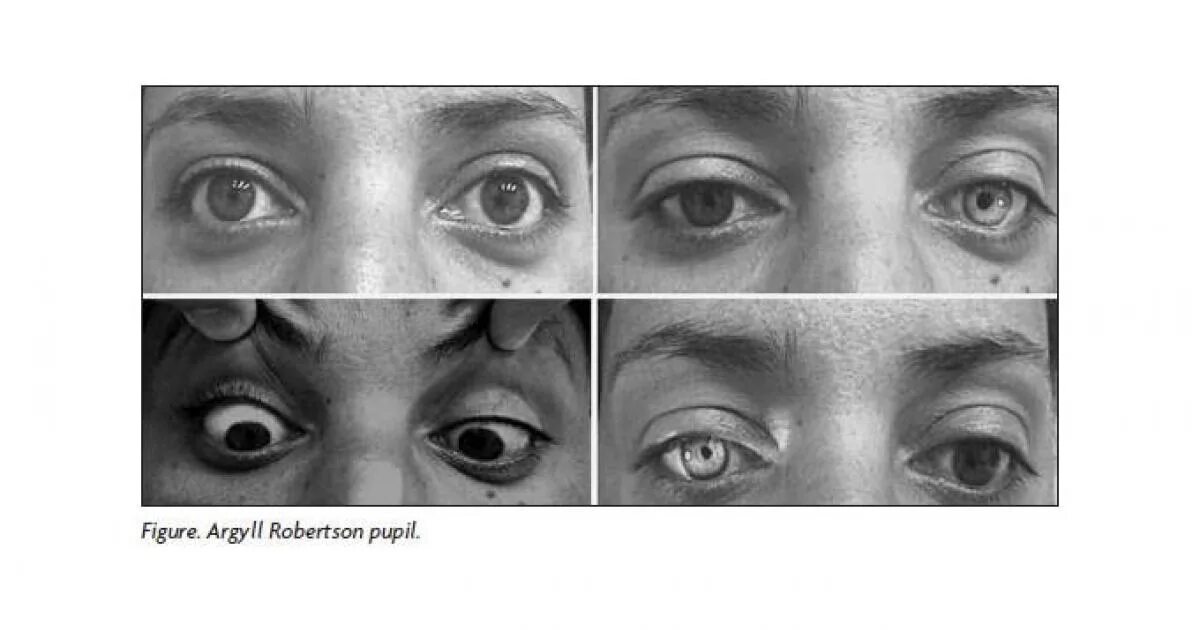 Симптом аргайль-робертсона. Симптом аргайла робертсона. Обратный синдром арджил-робертсона. Синдром арджил робертсона. Симптом аргайла робертсона.