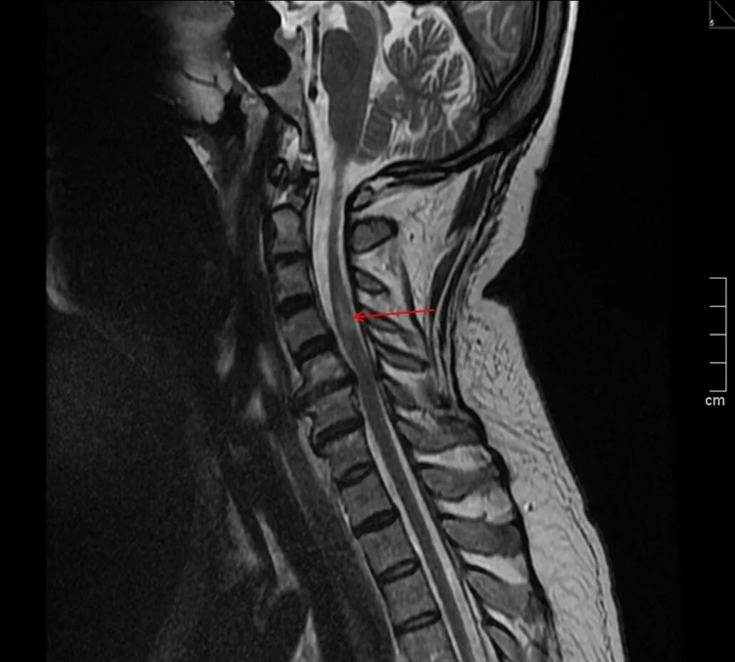Боль в спинном мозге. Ишемический спинальный инсульт. Спинальный инсульт мрт. Спинальный инсульт шейного отдела позвоночника на мрт. Миелопатия спинного мозга мрт.