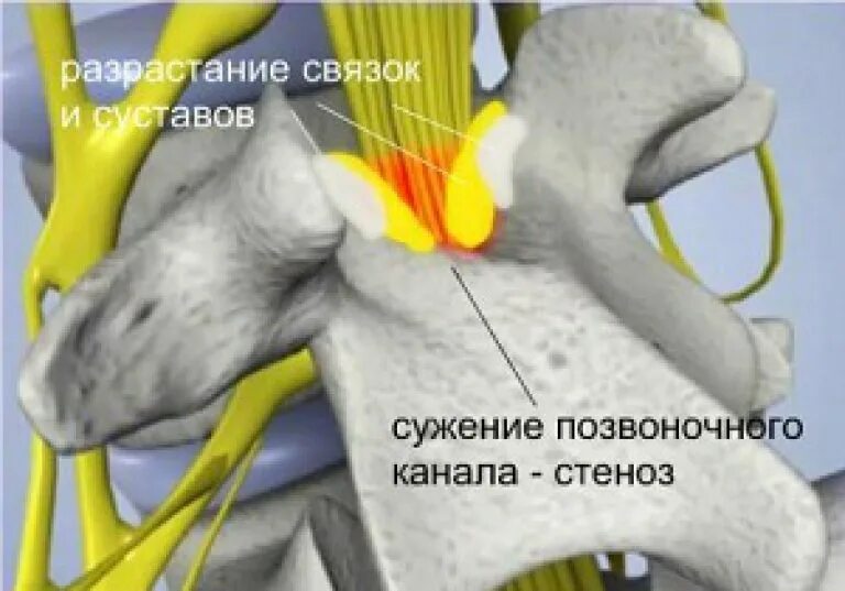 Желтая связка позвоночника. Стеноз позвоночного канала. Связки позвоночного канала. Стенозирование позвоночного канала. Крестцовый стеноз