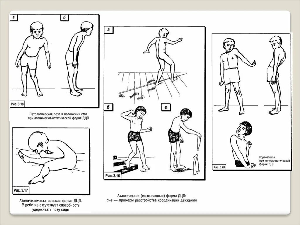 Дцп атонически астатическая. Атонически-астатическая форма ДЦП. Атонически-астатическая форма церебрального паралича. Детский церебральный паралич атонически-астатическая форма. Атонически-астатическая форма ДЦП характеризуется.