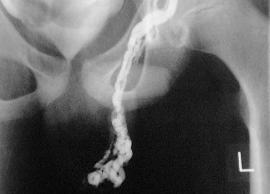 Частота рецидива при варикоцеле. Варикоз семенного канатика фото. Частота рецидива при варикоцеле. Варикоцеле рецидив после операции. Варикоцеле рецидив после операции.