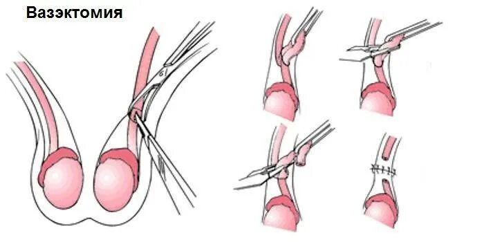 Вазэктомия стерилизация. Хирургическая стерилизация вазэктомия. Вазэктомия пункционная. Хирургическая стерилизация мужская.