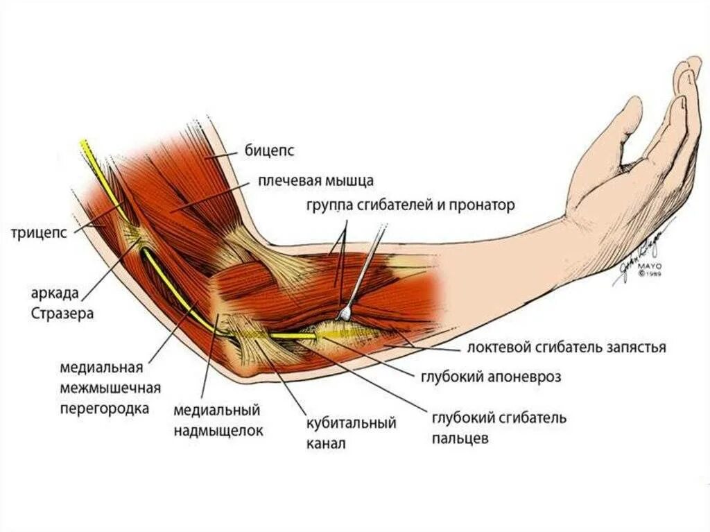 Лечение предплечья. Кубитальный канал локтевого сустава. Кубитальный туннельный синдром. Нервы локтевого сустава анатомия. Сухожилия локтевого сустава анатомия.