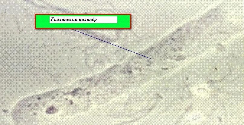 Повышенные цилиндры в моче. Микроскопия мочи гиалиновые цилиндры. Цилиндры гиалиновые -1 – 2 в п/ЗР. Цилиндрурия гиалиновые цилиндры. Единичные гиалиновые цилиндры в моче.