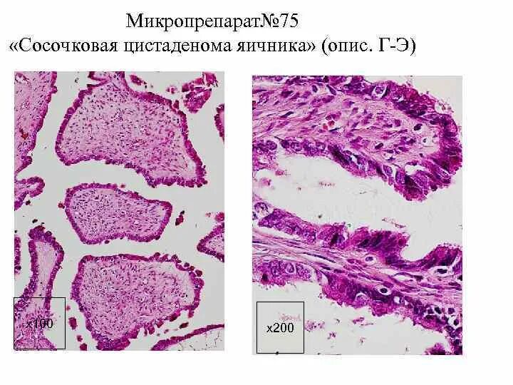 Гистология цистаденомы. Гистология цистаденомы