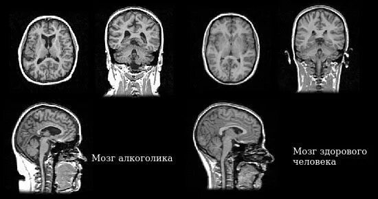 Алкогольная энцефалопатия код. Мрт головного мозга алкоголика. Мозг алкоголика и здорового. Мрт здорового мозга и мозга алкоголика. Головной мозг здорового человека и алкоголика.