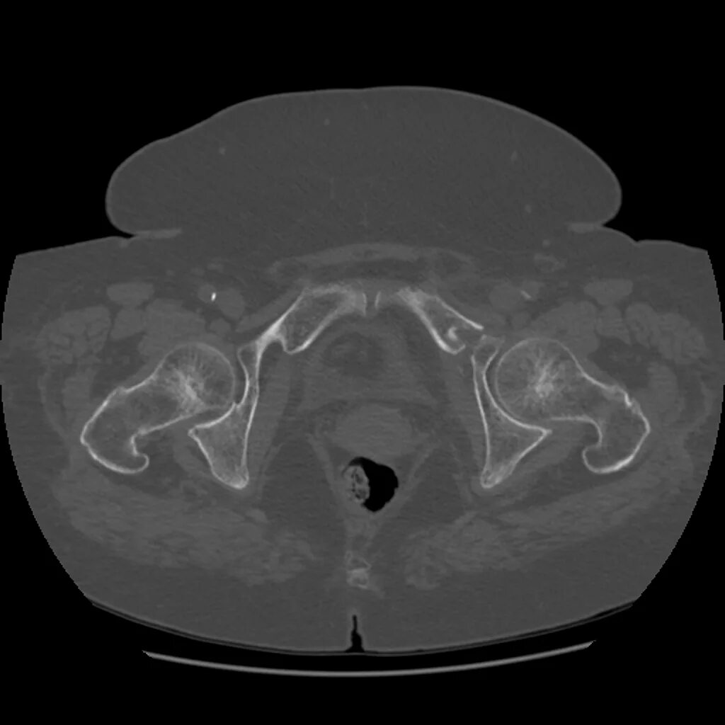 Кт подвздошной кости. Перелом лонной кости кт. Перелом костей таза кт. Экзостоз лонной кости кт. Перелом седалищной кости кт.