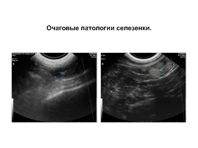 Очаговое образование селезенки. Патология селезенки на УЗИ. Образования селезенки на УЗИ. УЗИ патологии образовании селезенки. Очаговые образования селезенки на УЗИ.