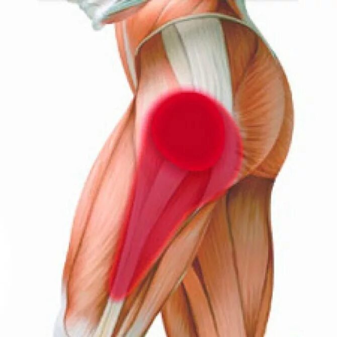 Бурсит трохантерит тазобедренного сустава. Трохантерит тазобедренного сустава . Сухожилия. Трохантерит тазобедренного сустава мышцы. Тендовагинит сухожилий тазобедренного сустава. Сильно болит бедро ноги