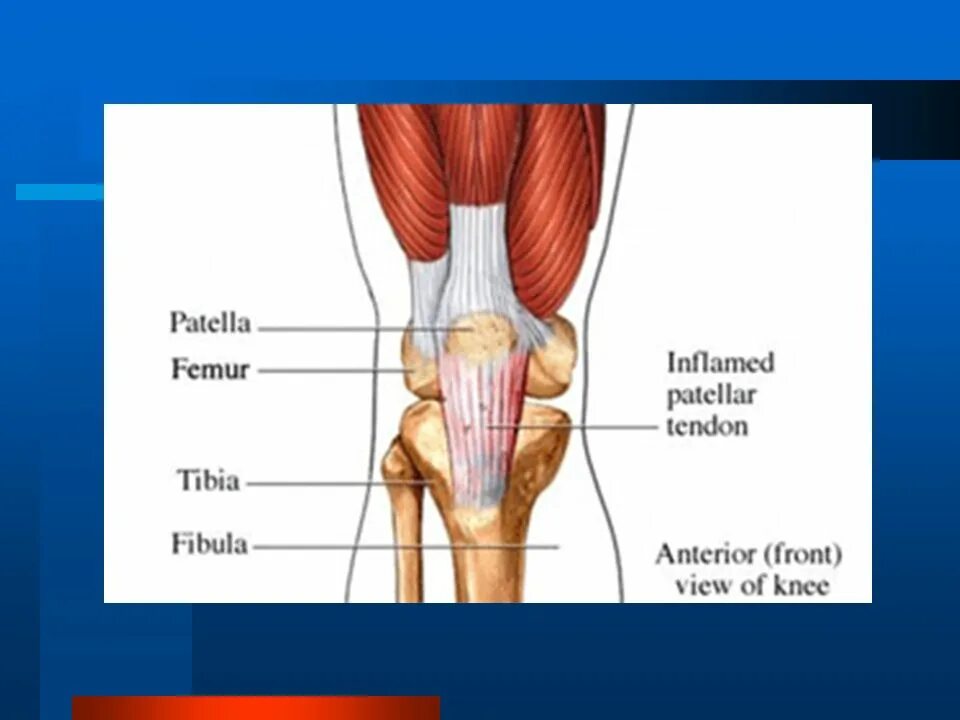 Воспаление коленных связок лечение. Тендинит сухожилия четырехглавой мышцы коленного сустава. Колено прыгуна тендинит надколенника. Связки надколенника анатомия. Тендинит сухожилия четырехглавой мышцы бедра мрт.