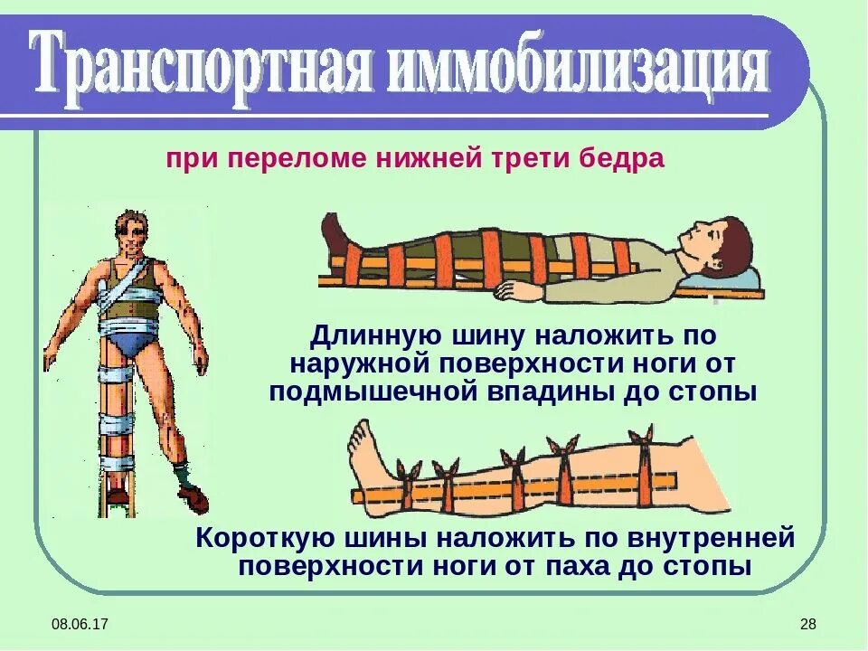 Транспортная иммобилизация при переломе шейки бедра. Шина дитерихса и шина крамера. Транспортная шина при фиксации перелома бедра. Транспортная иммобилизация при переломе бедренной кости. Иммобилизация шиной дитерихса.