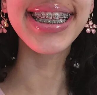 Pin by surovtsevva on my aesthetic Cute braces, Braces.