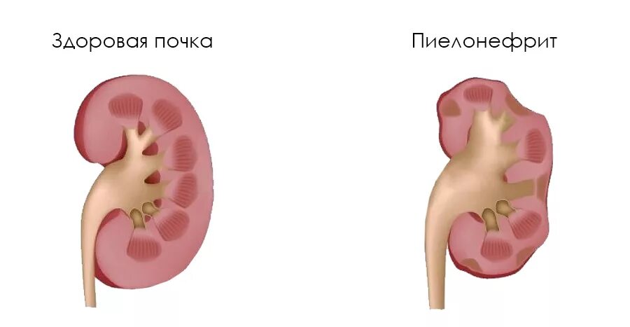 Почечная болезнь пиелонефрит. Почечное заболевание пиелонефрит. Односторонний хронический пиелонефрит. Острый пиелонефрит почек симптомы.