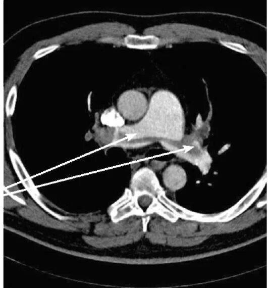 кт с контрастом в ростове. компьютерный томограф 2021. контрастирование легких на кт. Siemens 1,5 тл. тромбоэмболия легочной артерии на кт.