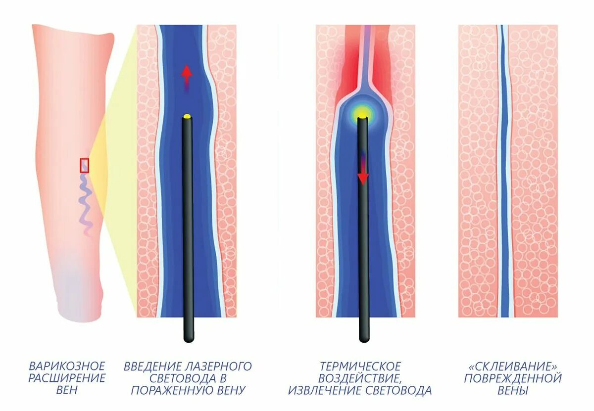 Лазерная коагуляция БПВ. Лазерная облитерация БПВ. Лазерная коагуляция после операции