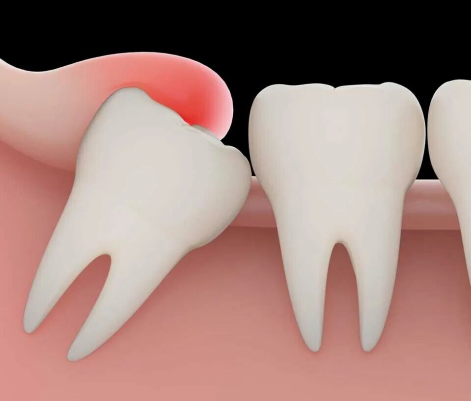 Стоматология мудрый. Перикоронит зуба мудрости.
