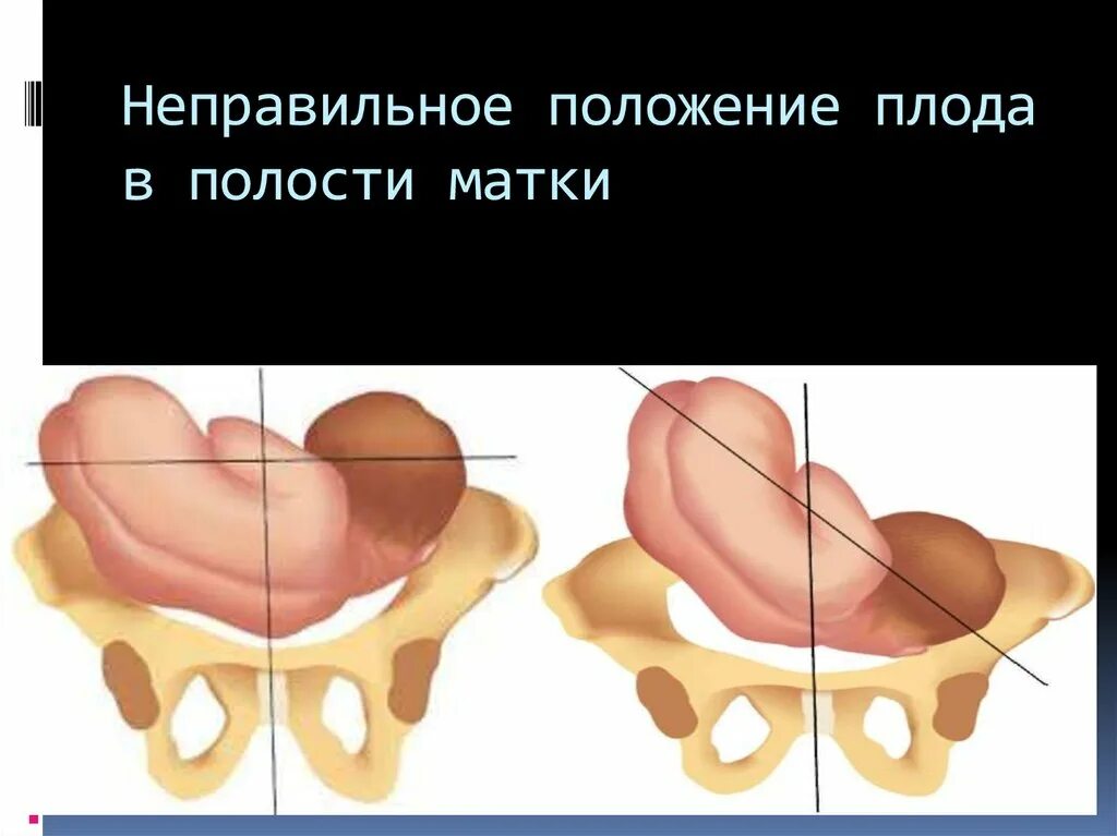 Неправильное положение плода. Неправильные положения плода поперечное косое. При неправильном положении плода. Неправильное положение плода осложнения. Запущенное положение плода