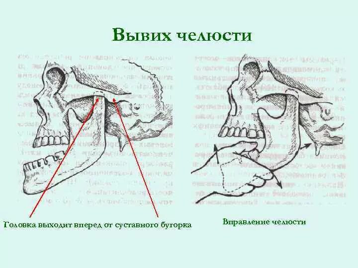 Вывих верхней челюсти. Вывих и подвывих нижней челюсти. вывихи внчс классификация. вправление вывиха височно-нижнечелюстного сустава. метод блехмана вправление челюсти.