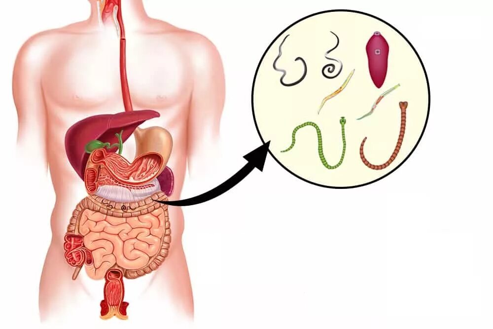 Признаки червей в организме человека. Червь в организме человека. Червячки в организме человека. Паразиты в кишечнике человека.