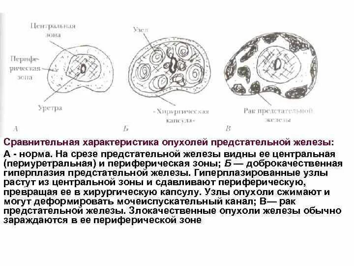 Узел в простате. Узлы предстательной железы. Узелок предстательной железы. Транзиторная зона предстательной железы.