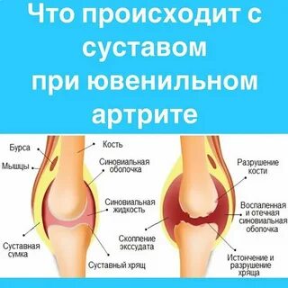 Выпот коленного сустава что это
