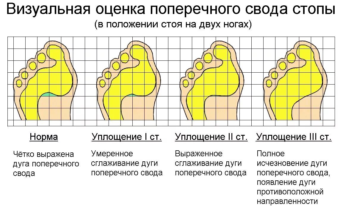 Плантограмма при поперечном плоскостопии. Свод стопы плоскостопие анатомия. Плоскостопие пронация стопы. Уплощение поперечного свода стопы. Установление свода