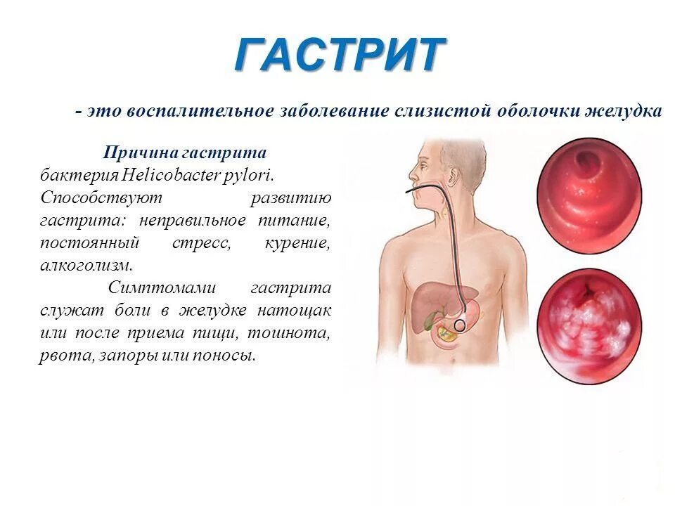 Гастрит желудка что делать