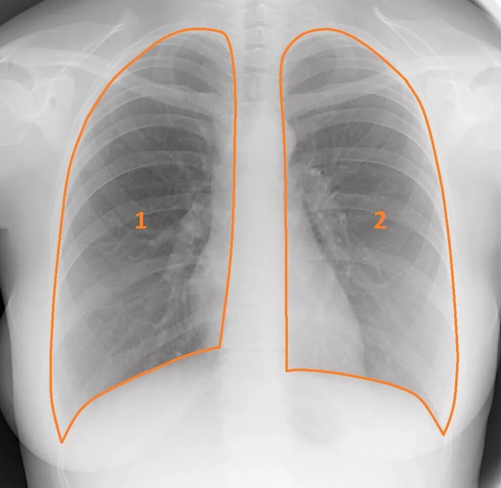 Плевральные синусы на рентгене. Реберно диафрагмальный угол на рентгене. Реберно диафрагмальный синус на рентгенограмме. Синусы ОГК рентген. Какие легкие в норме