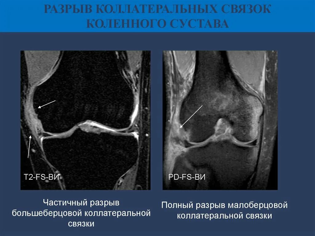 Обойтись разрыв. Травма малоберцовой коллатеральной связки. Разрыв малоберцовой коллатеральной связки. Разрыв большеберцовой коллатеральной связки. Разрыв коллатеральной связки коленного сустава мрт.