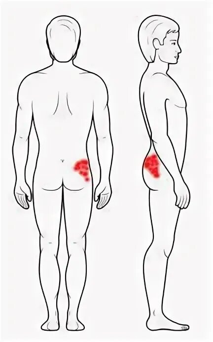 Болит правая ягодица и отдает в ногу