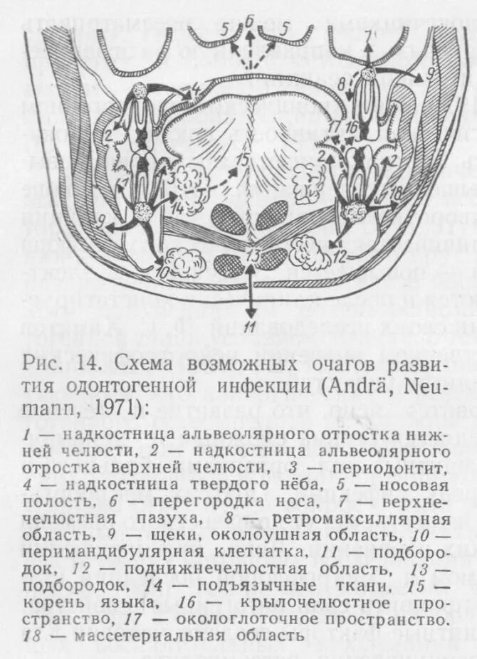 Пространства дна полости рта. Флегмона рта полости рта. Флегмона дна полости рта разрез. Флегмона полости рта операция. Абсцесс и флегмона дна полости рта.