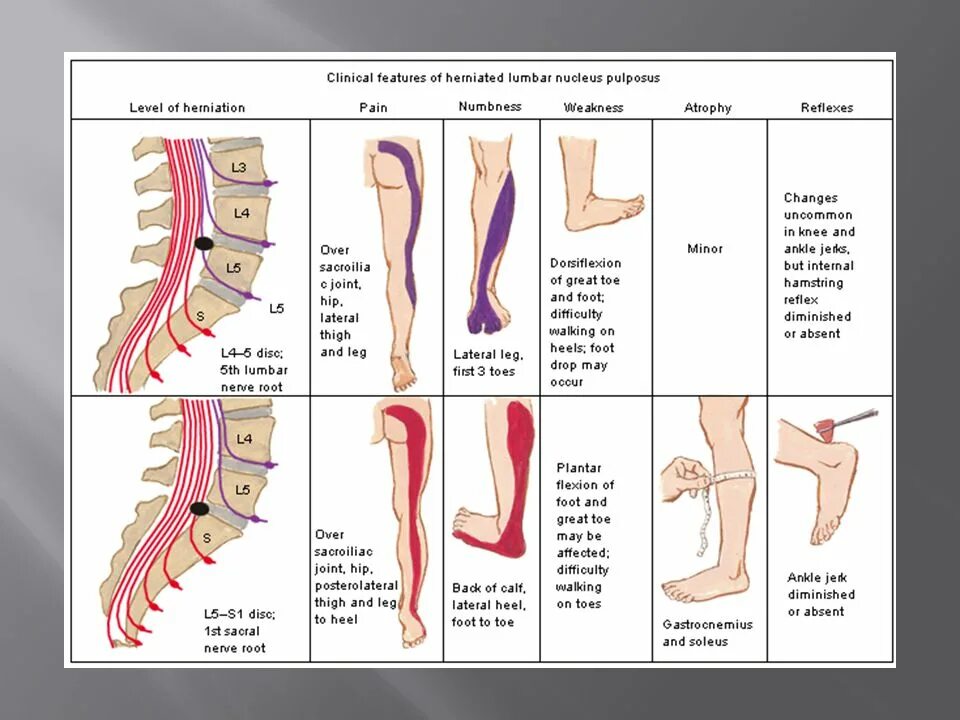 Позвоночник отделы l5 s1. L2 позвонок поясничного отдела. L5 s1 схема позвоночника грыжа. Грыжи позвоночника l3-l4,l4-l5,l5-s1. Диски позвонков l3-l4, l4-l5, l5-s1.