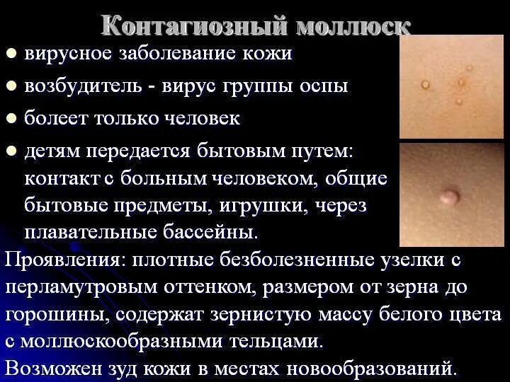 Вирусное заболевание моллюск контагиозный. Контагиозный моллюск патанатомия. Кожное заболевание кандидозный моллюск. Контагиозный моллбсками.