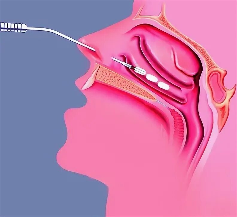 Гальванокаустика нижних носовых раковин. Радиоволновая вазотомия носовых раковин. Лазерная вазотомия нижних носовых раковин. Подслизистая вазотомия нижних носовых раковин. Вазотомия носовых раковин операция