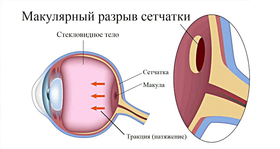 Разрыв сетчатки операция. Разрыв глазной сетчатки. Повреждение сетчатки