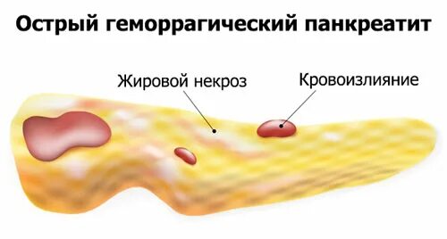 Что такое некроз поджелудочной железы у мужчин. Панкреонекроз жировой острый. Острый панкреатит отечный, геморрагический. Панкреонекроз: жировой, геморрагический, смешанный.. Жировой некроз поджелудочной железы гистология.