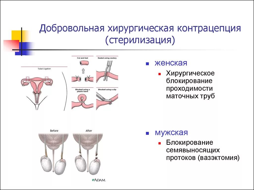 Перевязать трубы отзывы. Хирургические методы контрацепции. Мужская стерилизация. Добровольная хирургическая стерилизация методы контрацепции. Добровольная хирургическая стерилизация методики. Хирургические контрацепции (стерилизация) виды.