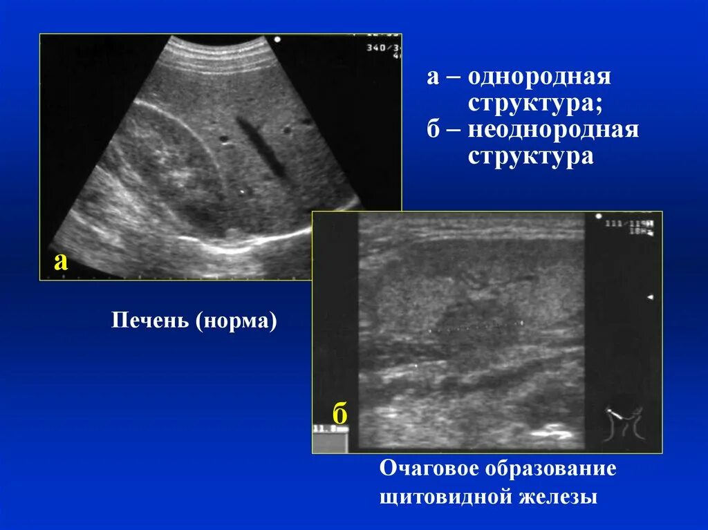 Неоднородная структура печени на УЗИ. Эхоструктура паренхимы неоднородная печени. Образования щитовидной железы на УЗИ. Эхоструктура диффузная поджелудочная железа