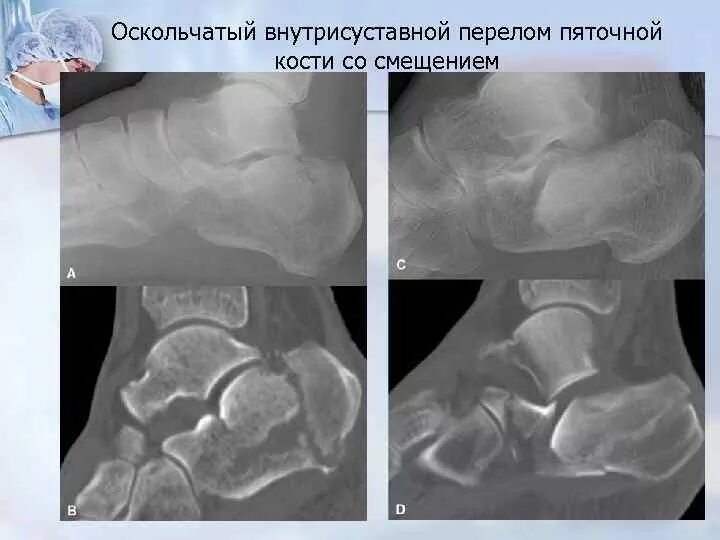 Операция пяточной кости. Пяточная кость перелом оскольчатый. Импрессионный перелом пяточной кости. Краевой перелом бугра пяточной кости. Оскольчатый перелом пяточной кости.