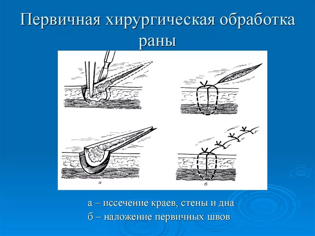 Первичная хирургическая обработка это. Швы на рану классификация. Первичная хирургическая обработка РАН. Первичная хирургическая обработка раны швы. Пхо РАН классификация.